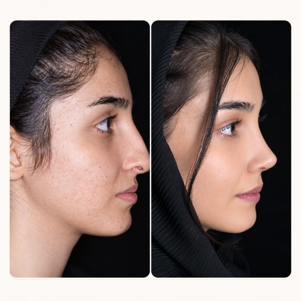 Side profile rhinoplasty before and after result by Dr. Katayoun Ansari