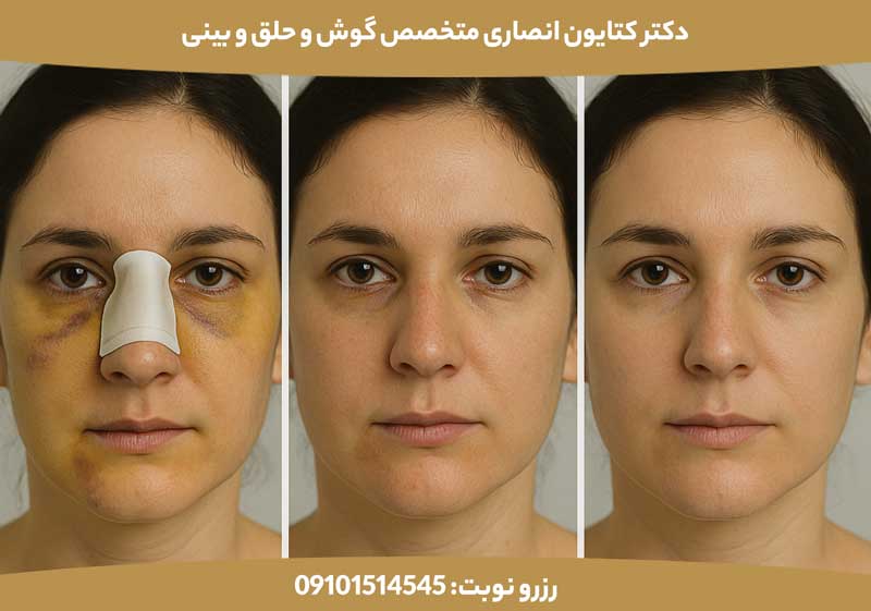 بیرون زدگی غضروف بینی