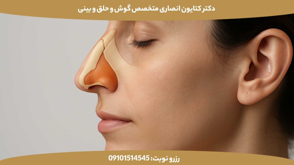 جوش خوردن استخوان بینی