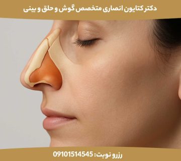 جوش خوردن استخوان بینی