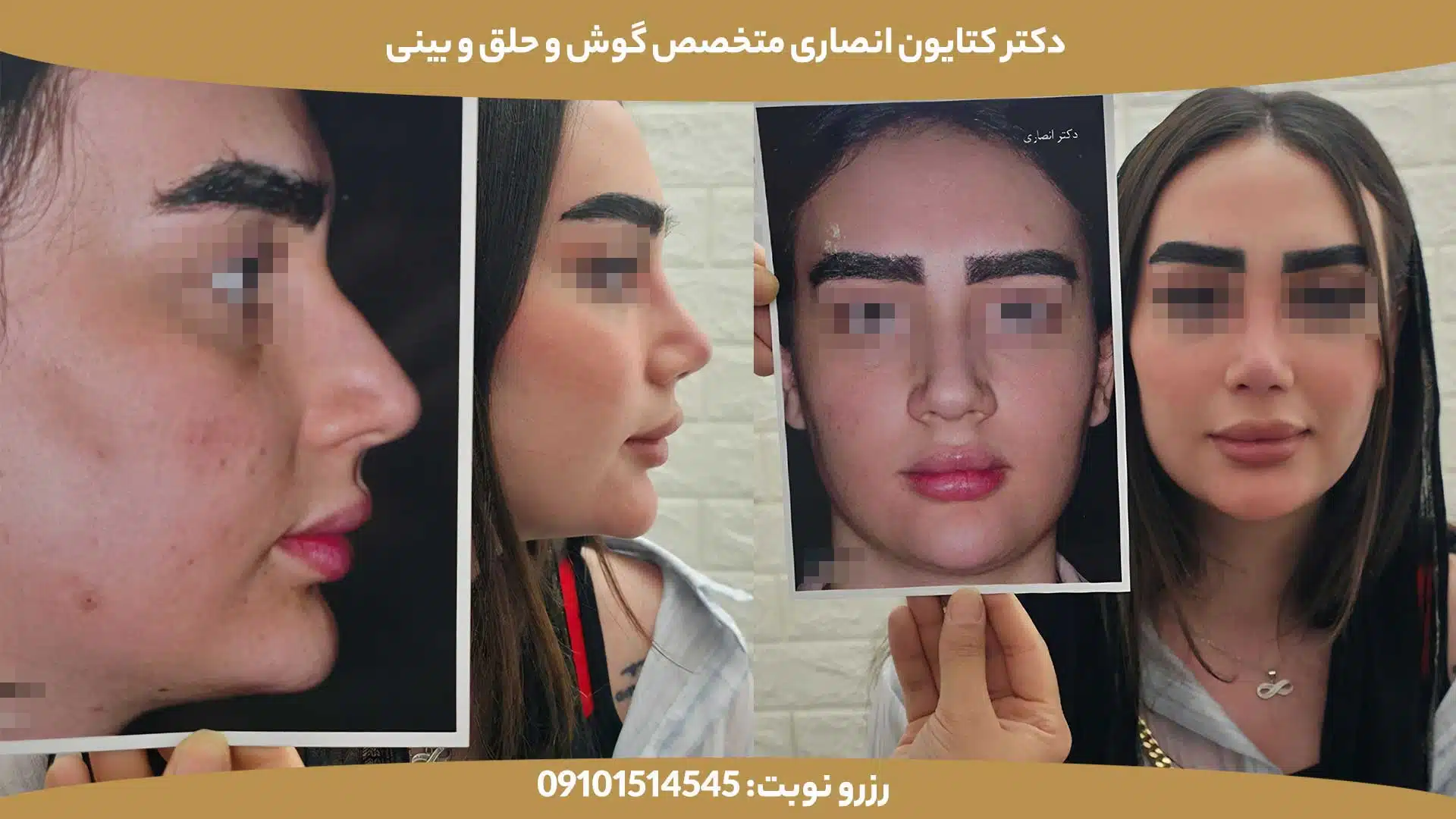 عکس قبل و بعد از عمل بینی توسط دکتر کتایون انصاری - کیس اول