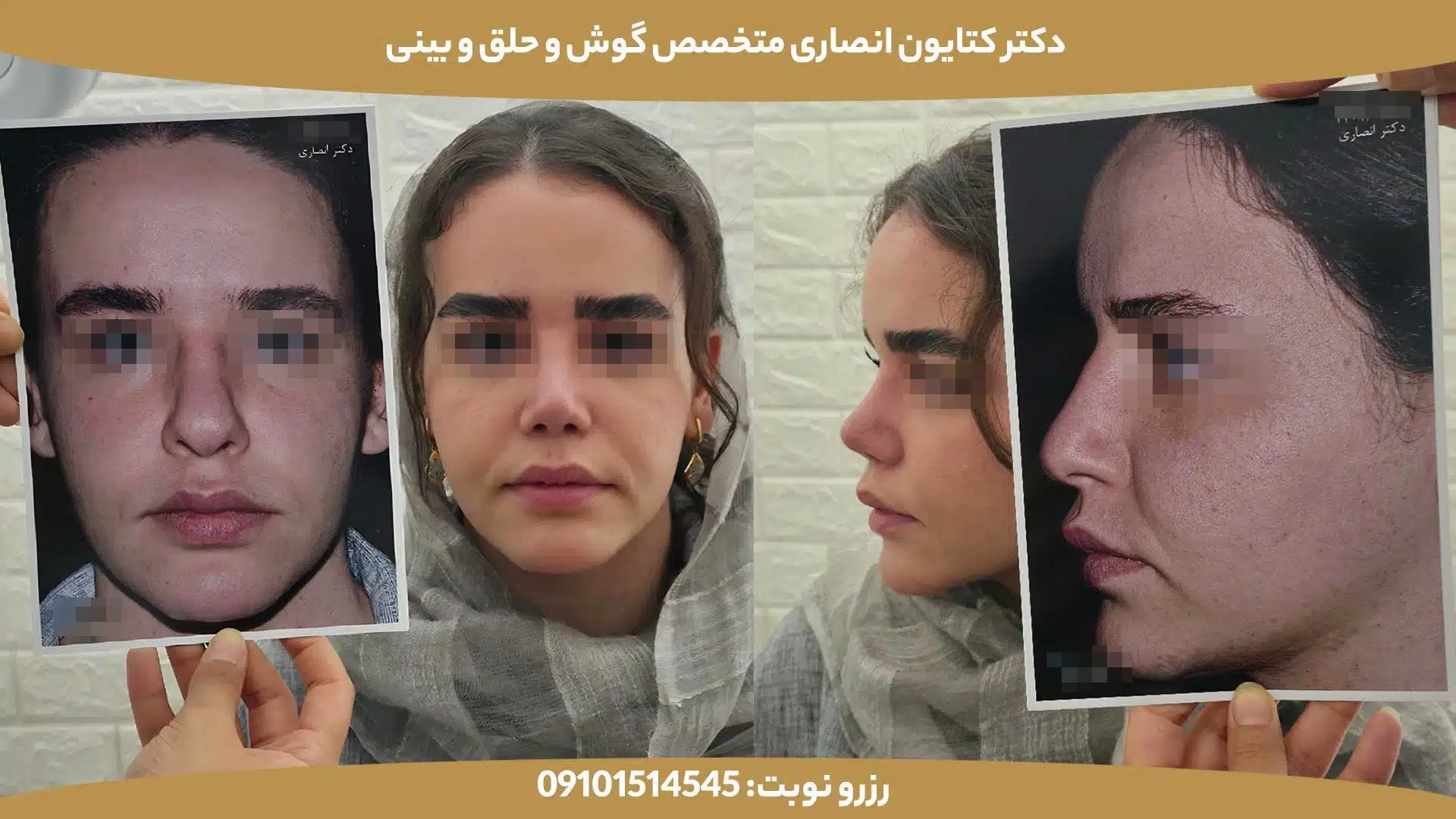 عکس قبل و بعد از عمل بینی توسط دکتر کتایون انصاری - کیس دوم