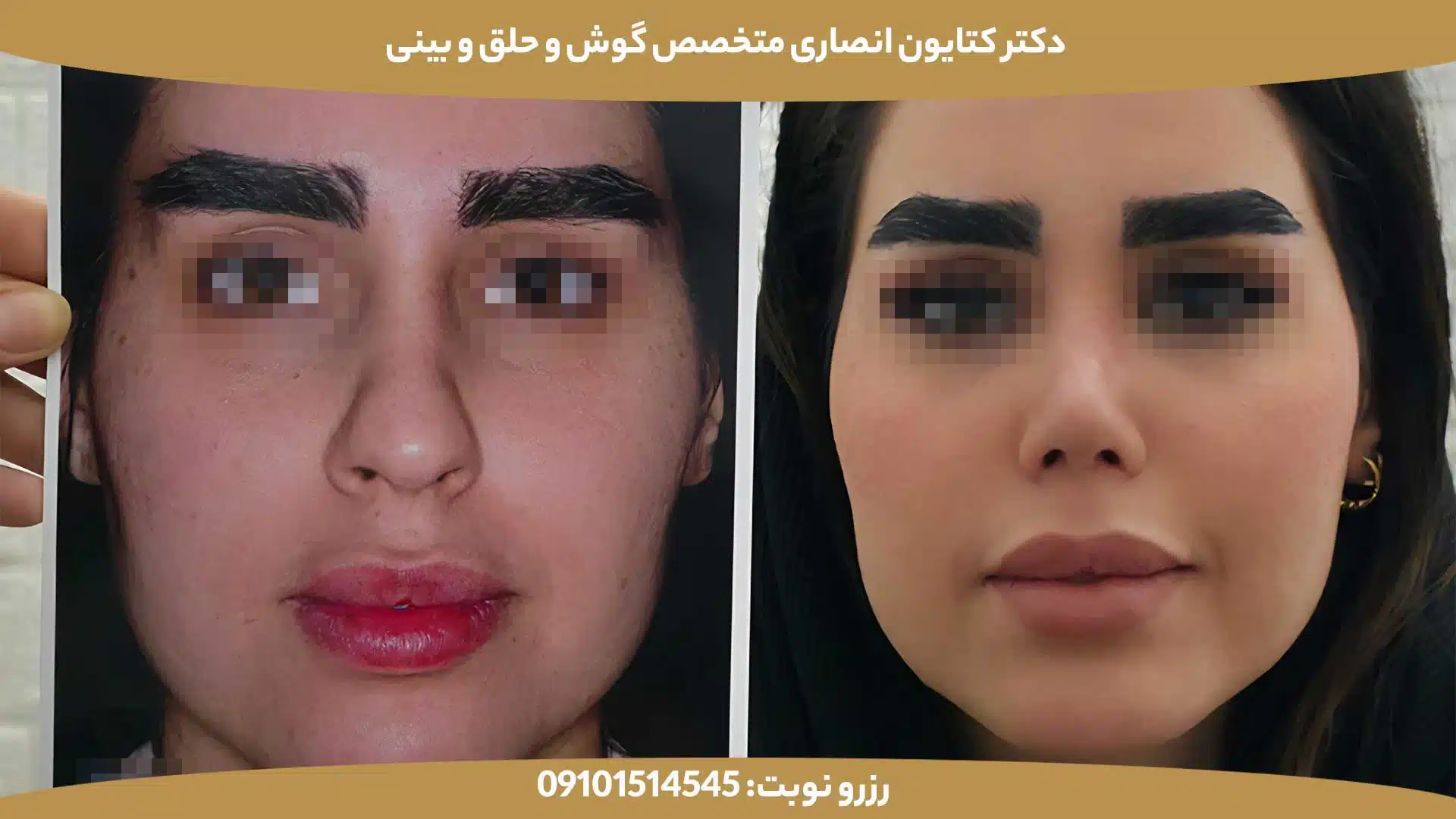 عکس قبل و بعد از عمل بینی توسط دکتر کتایون انصاری - کیس سوم