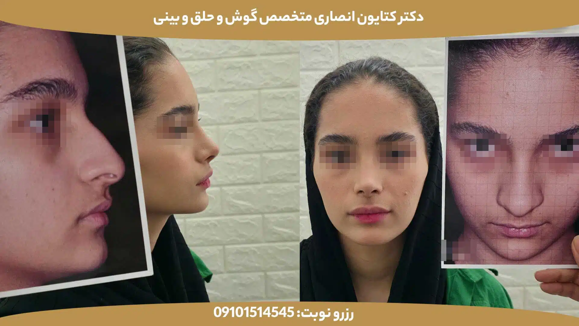 عکس قبل و بعد از عمل بینی توسط دکتر کتایون انصاری - کیس چهارم