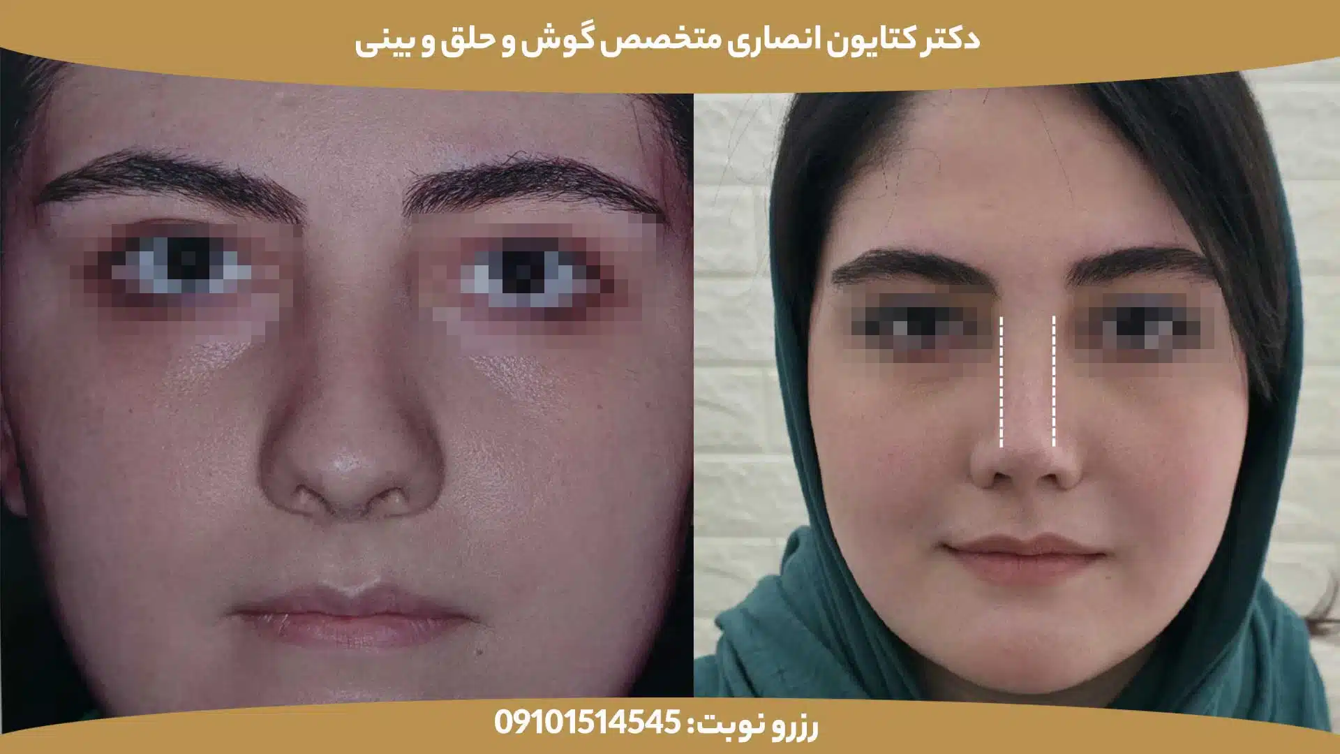 عکس قبل و بعد از عمل بینی توسط دکتر کتایون انصاری - کیس پنجم