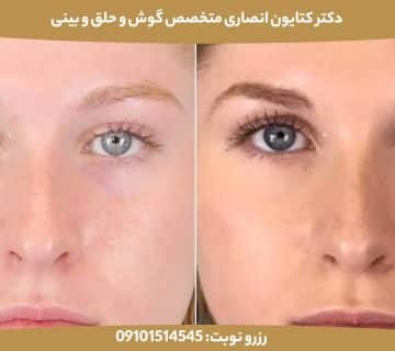 بررسی تأثیر عمل بینی بر پوست و بافت‌های اطراف: تغییرات کوتاه‌مدت و بلندمدت