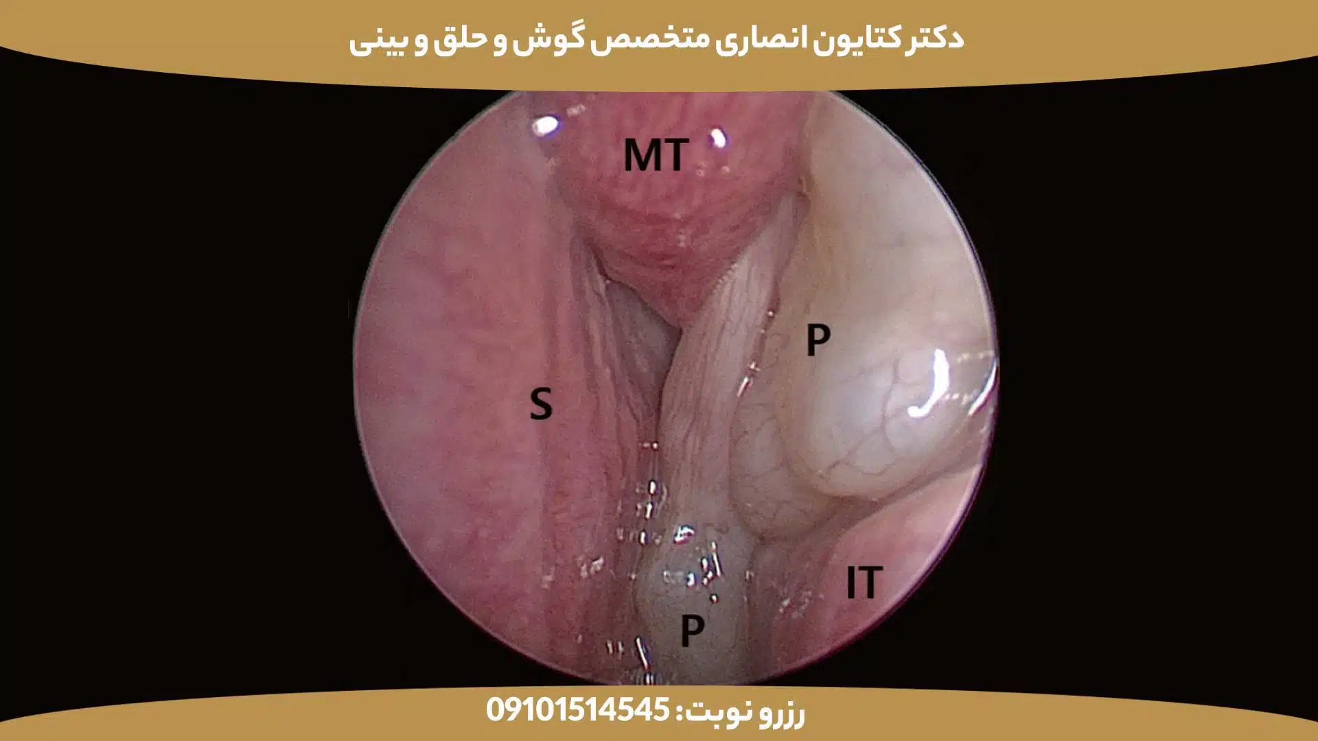 تصویر آندوسکوپی از پولیپ بینی در حفره بینی