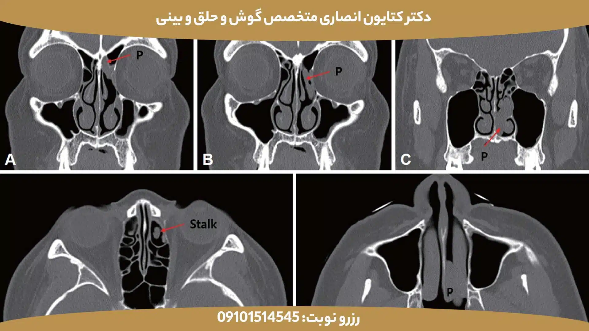 تصویر سیتیاسکن سینوس با پولیپهای بینی