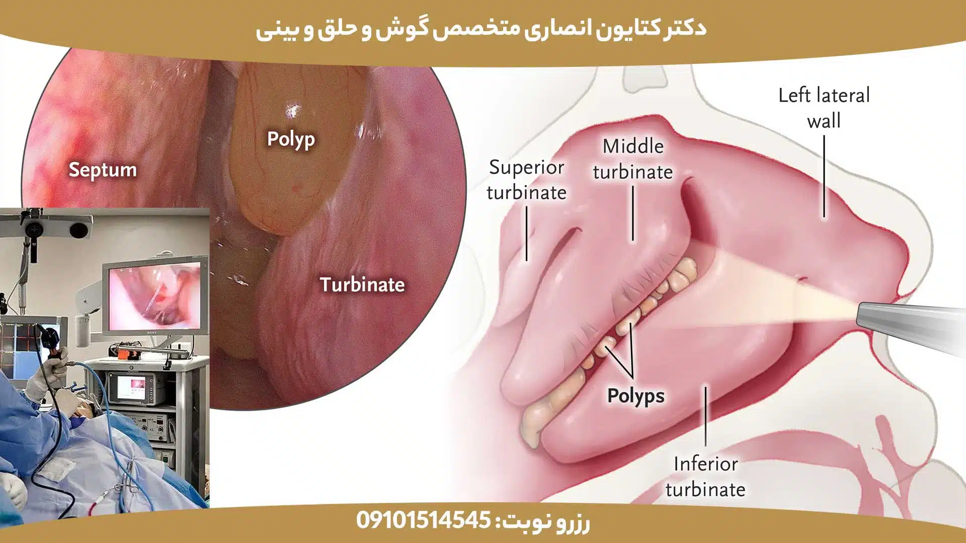 تصویر شماتیک از برداشتن پولیپ بینی با جراحی اندوسکوپیک