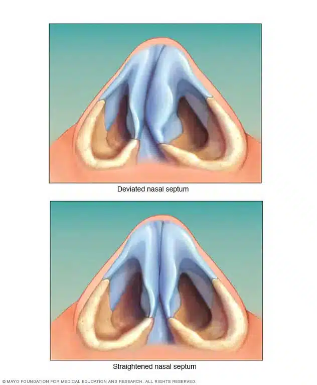 تیغه بینی کج (Deviated septum) وقتی تیغهی بینی به یک سمت منحرف شود و در جای درست خود قرار نداشته باشد، یکی از مجراهای بینی کوچکتر از دیگری میشود.