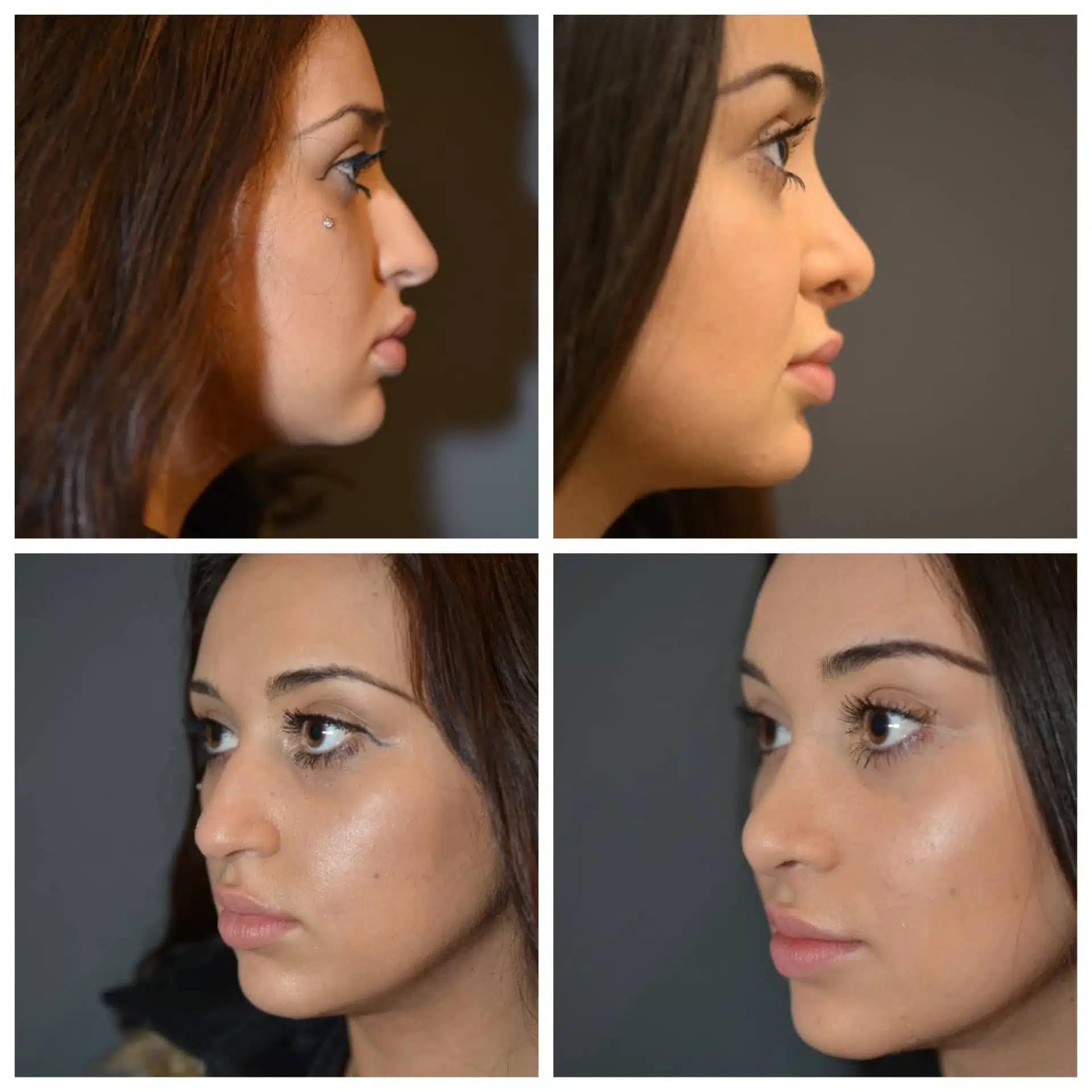 جراحی بینی یا رینوپلاستی (Rhinoplasty)