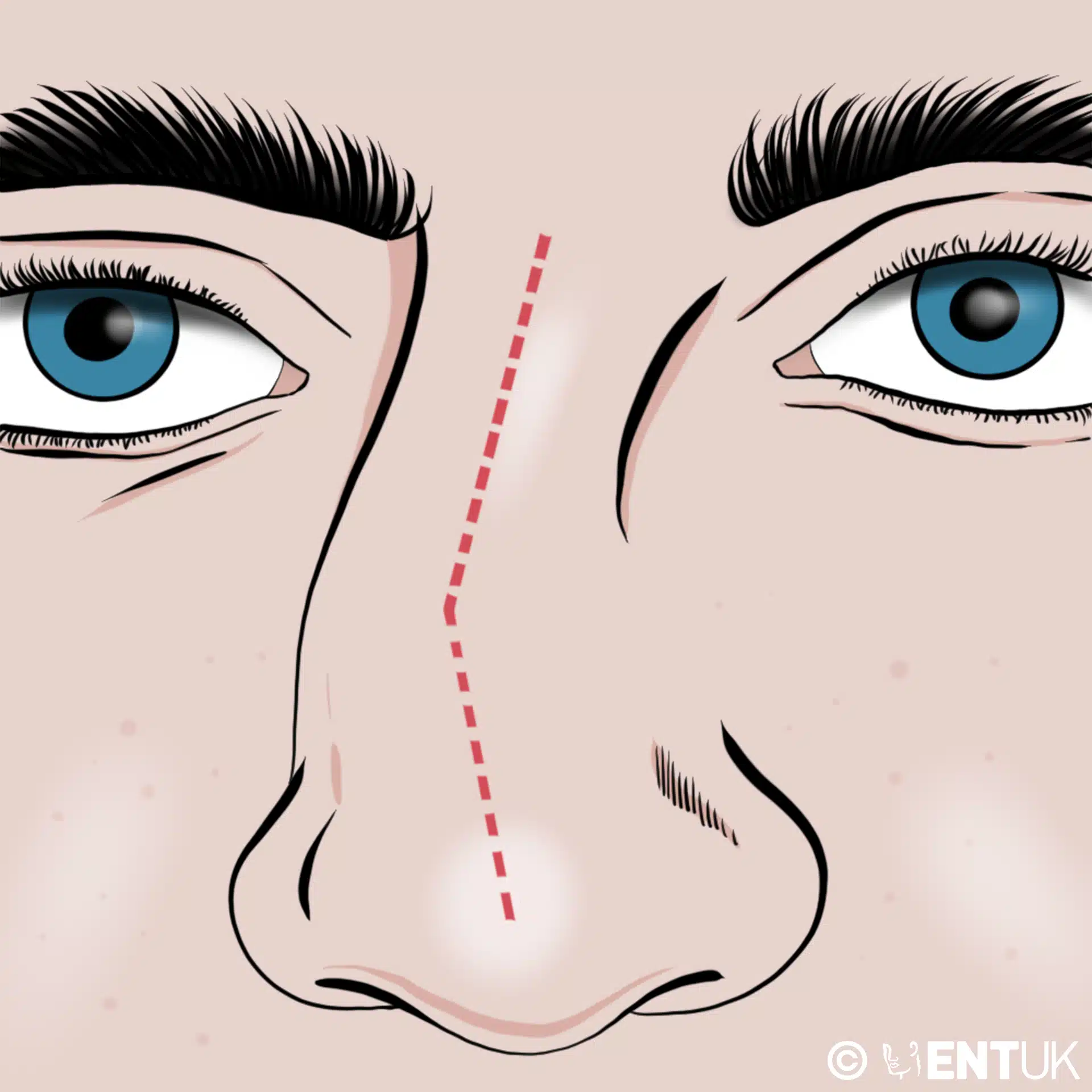 چرا سپتورینوپلاستی انجام میشود؟