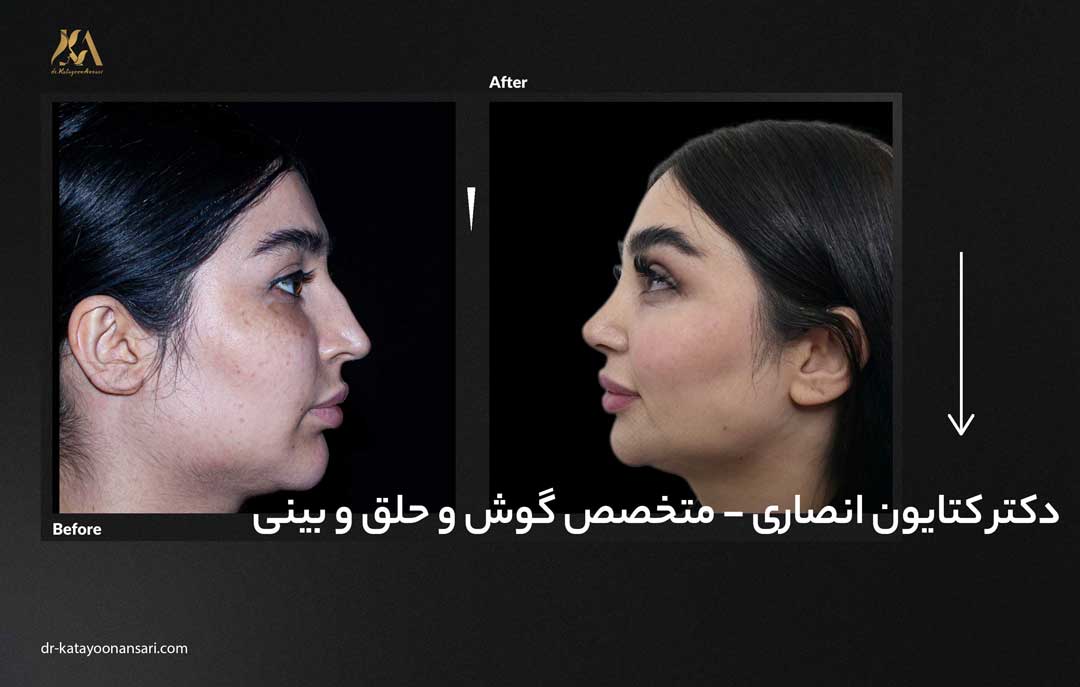 dr-katayoonansari-rhinoplasty-Befor_After_1