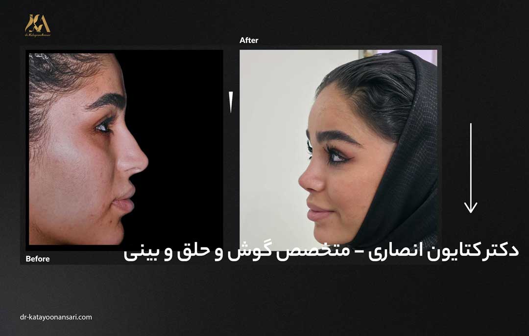 dr-katayoonansari-rhinoplasty-Befor_After_2