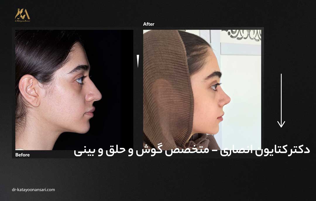 dr-katayoonansari-rhinoplasty-Befor_After_3
