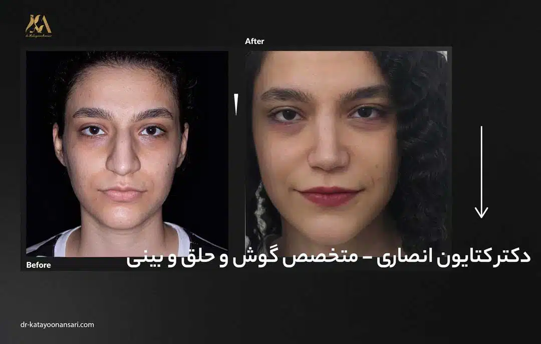 dr-katayoonansari-rhinoplasty-Befor_After_4