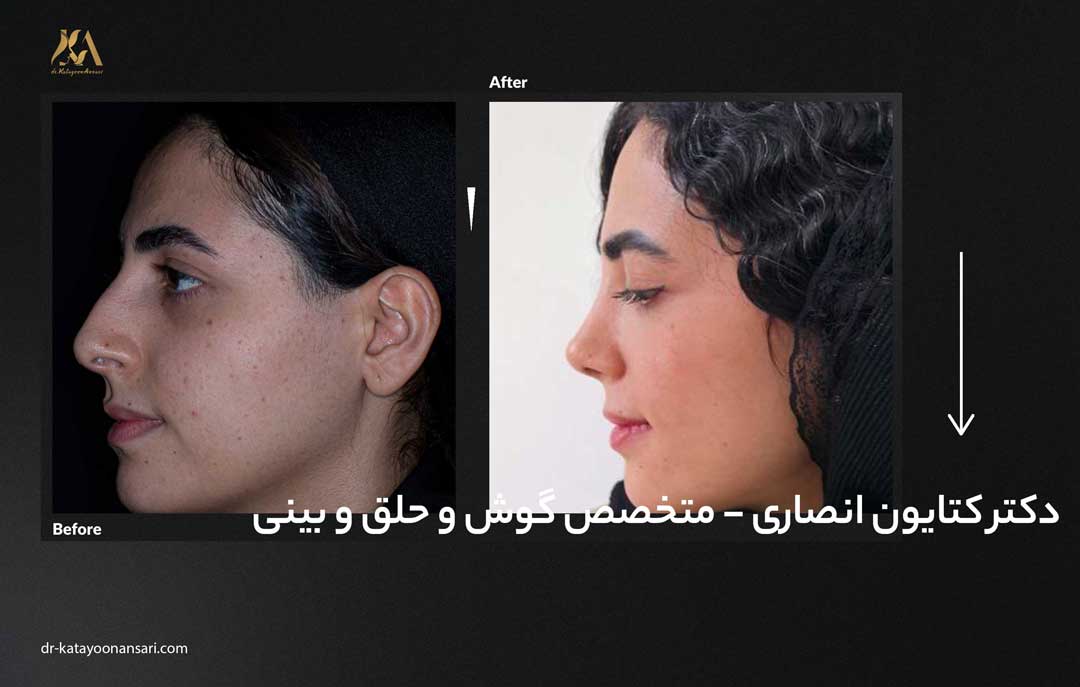 dr-katayoonansari-rhinoplasty-Befor_After_5