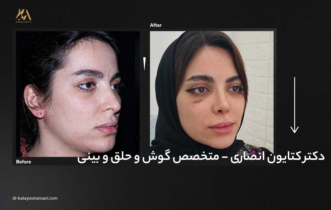dr-katayoonansari-rhinoplasty-Befor_After_6
