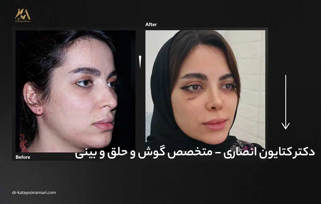 dr-katayoonansari-rhinoplasty-Befor_After_6