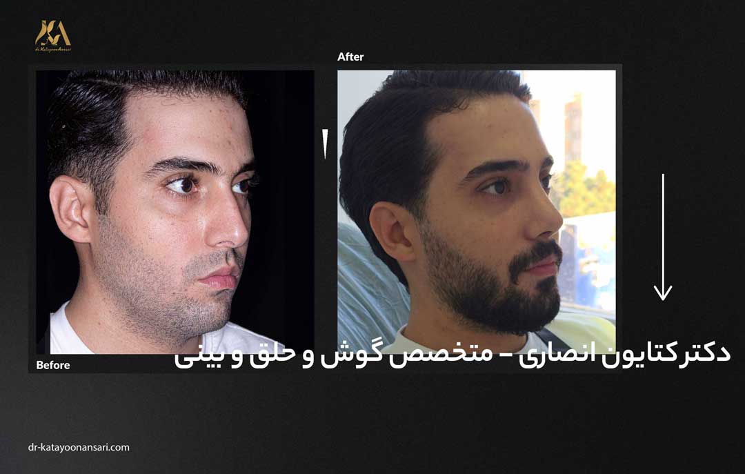 dr-katayoonansari-rhinoplasty-Befor_After_7