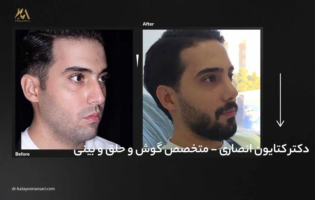dr-katayoonansari-rhinoplasty-Befor_After_7