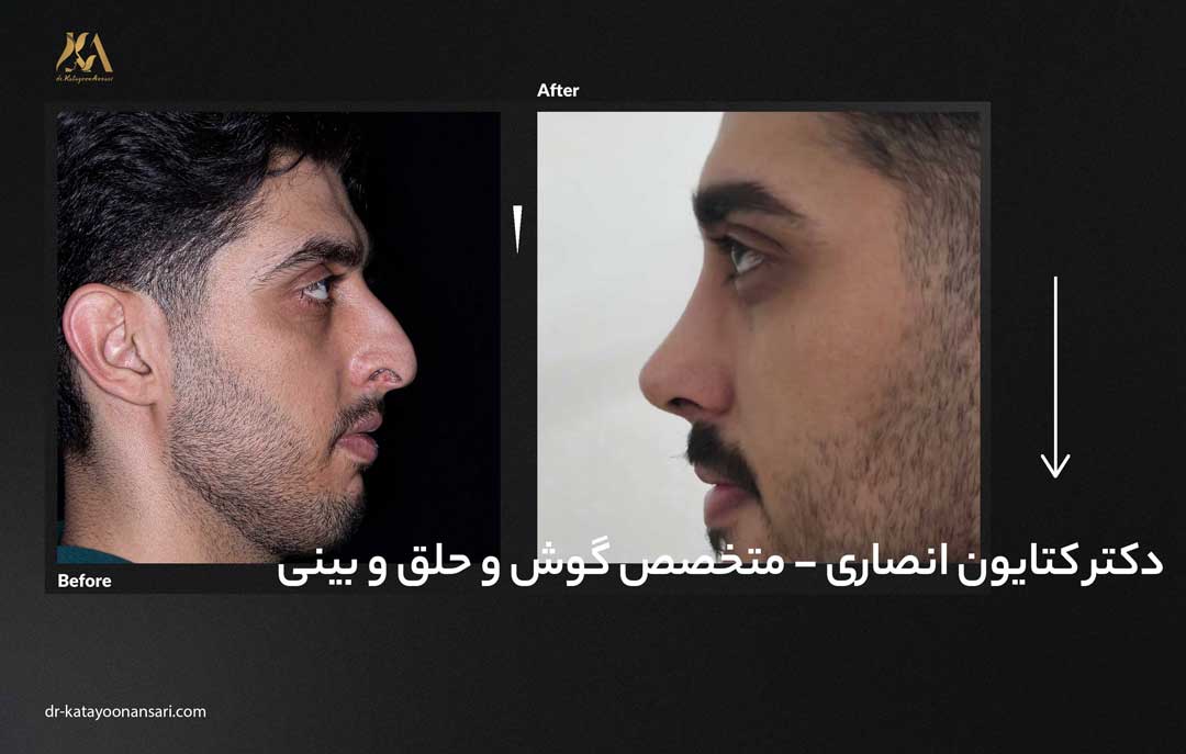 dr-katayoonansari-rhinoplasty-Befor_After_8