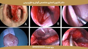 رینوپلاستی اندوسکوپیک چیست؟ | تحولی در جراحی دقیق و کمتهاجمی بینی