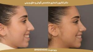 رینوپلاستی (Rhinoplasty): هرآنچه باید درباره عمل زیبایی بینی بدانید
