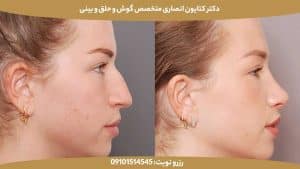 سپتورینوپلاستی چیست؟ | ترکیب زیبایی و درمان در یک جراحی بینی کامل