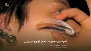 عمل بینی بدون تامپون | نسل جدید رینوپلاستی بدون درد و بدون خونریزی