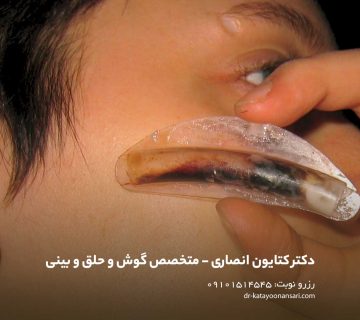 عمل بینی بدون تامپون | نسل جدید رینوپلاستی بدون درد و بدون خونریزی