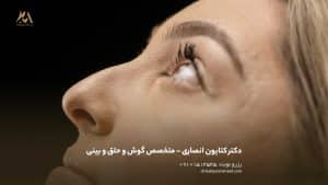 مشاوره قبل از عمل بینی | راهنمای کامل از تصمیم‌گیری تا روز جراحی