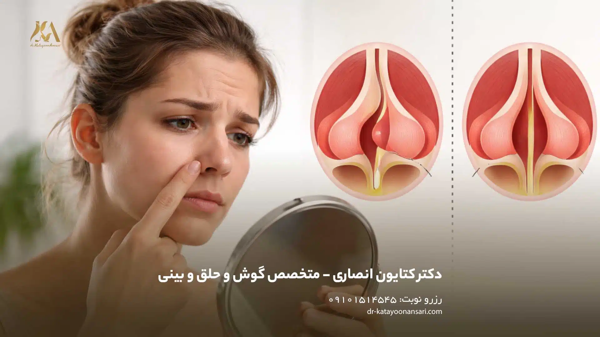 انحراف بینی یا انحراف تیغه بینی