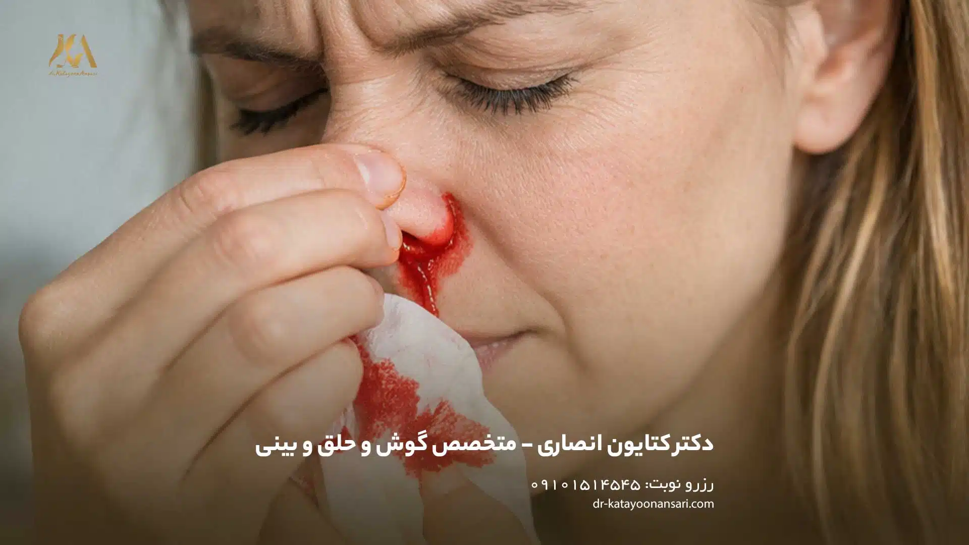 خوندماغ، خونریزی بینی یا نام علمی آن اپیستاکسی (Epistaxis)